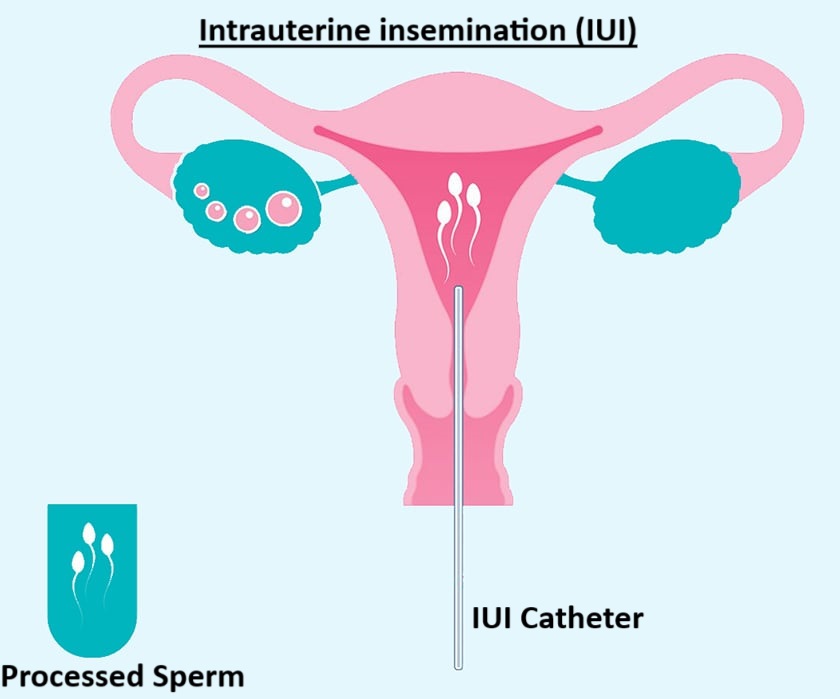 IUI Treatment Process, 